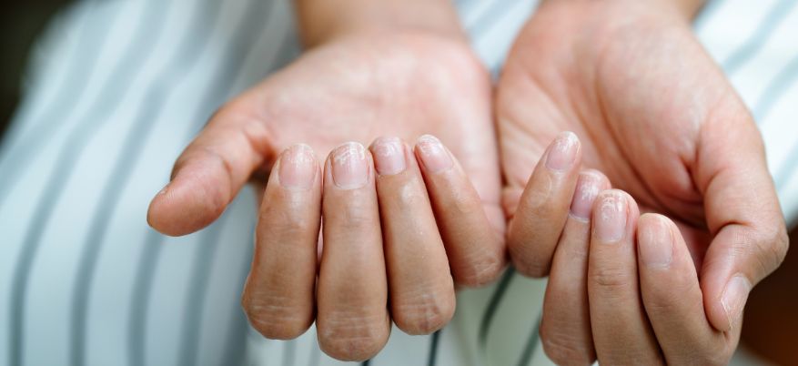 Rimedi per unghie fragili: cause e trattamenti efficaci