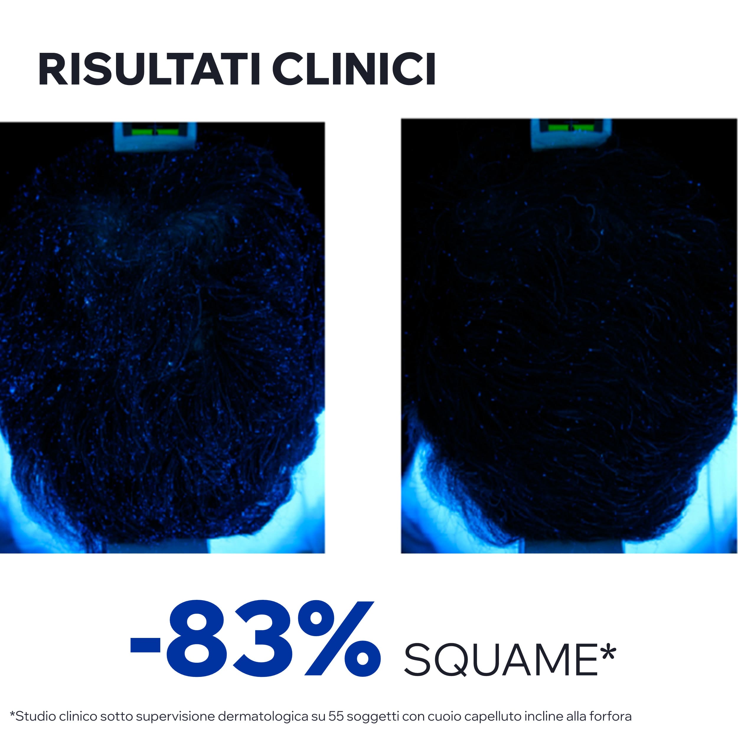Uriage DS Hair - Lozione Antiforfora Intensiva Per Forfora Grassa O Secca 100 ml