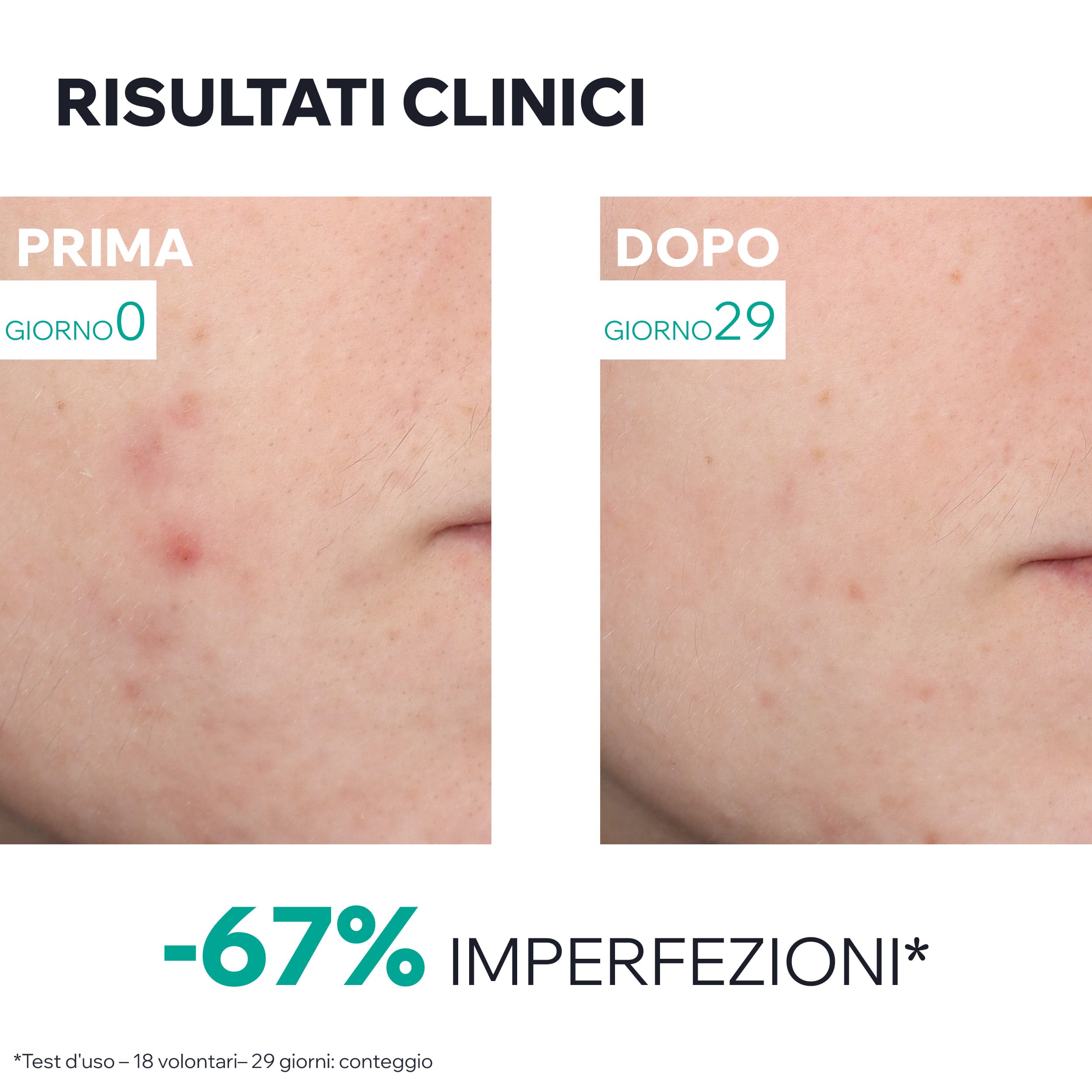 Uriage Hyséac - Siero Anti-Imperfezioni Pelle Nuova Viso 30 ml
