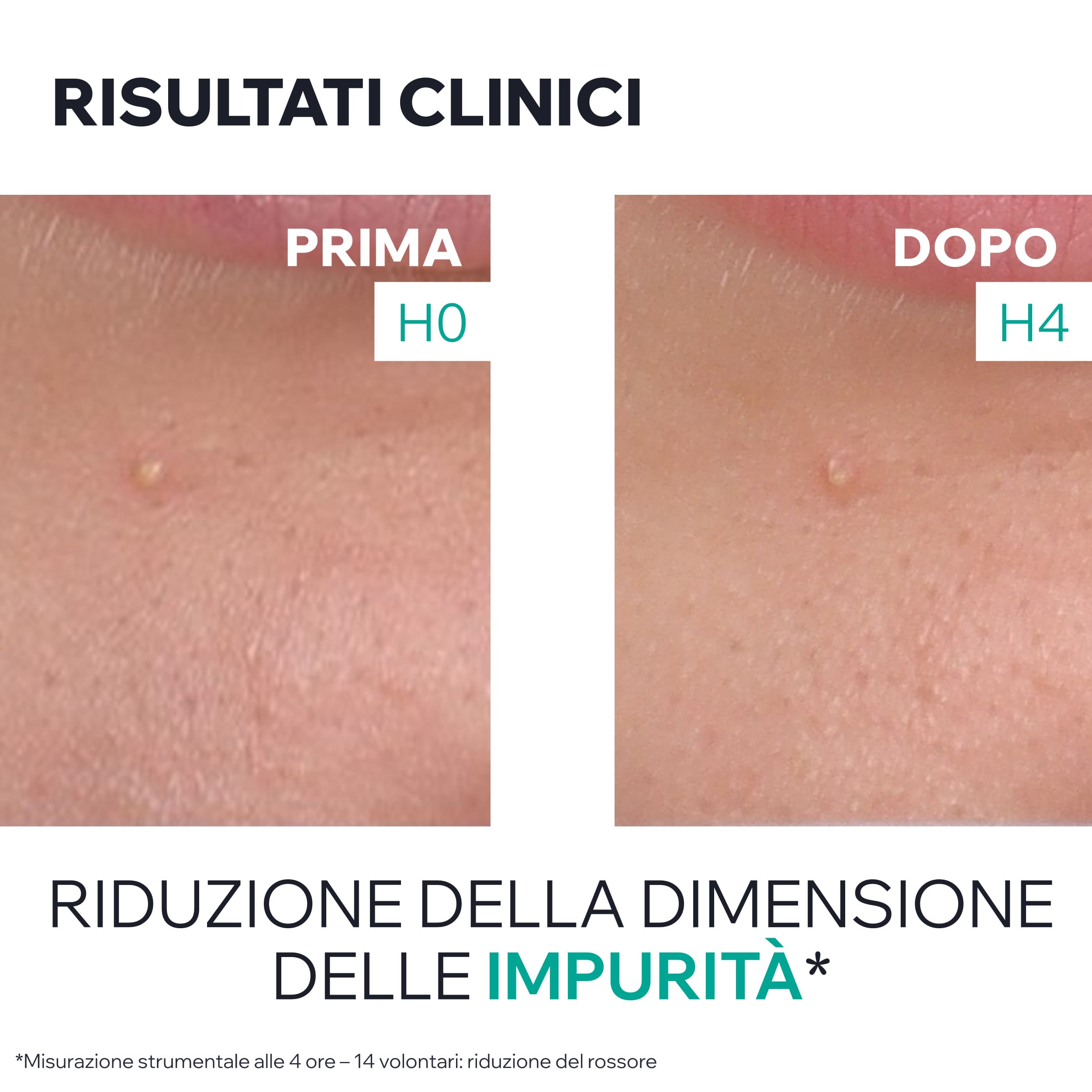 Uriage Hyséac - Gel SOS Purificante Anti-Imperfezioni Viso 15 ml