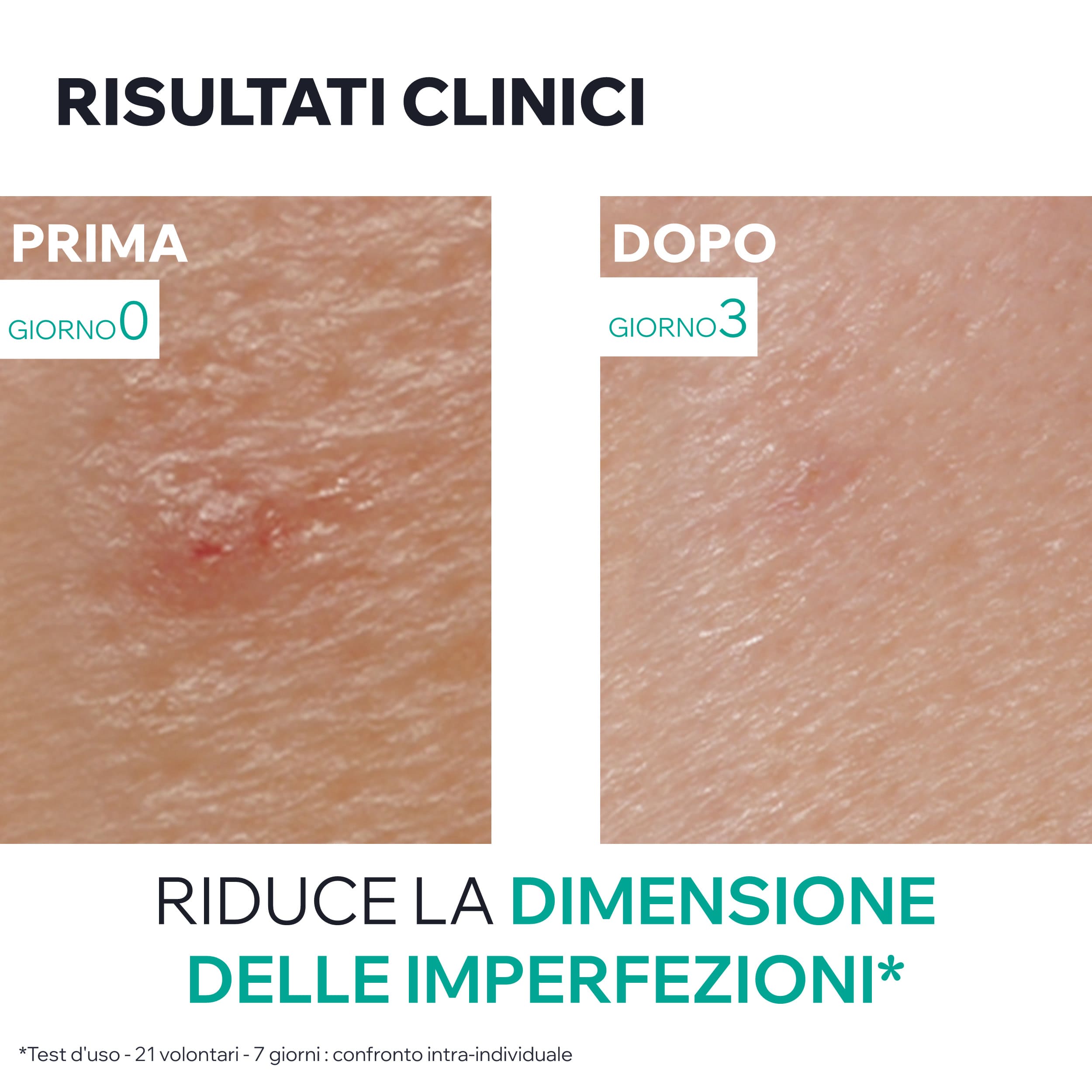 Uriage Hyséac - Pasta SOS Trattamento Notte Anti-Imperfezioni Viso 15 g