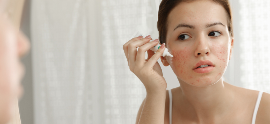 Rosacea che cos'è e perchè compare